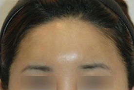 매몰법 전 AFTER 1