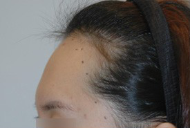 매몰법 전 BEFORE 1