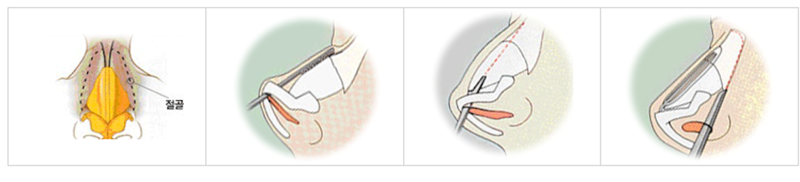 코 끝 성형술 방법