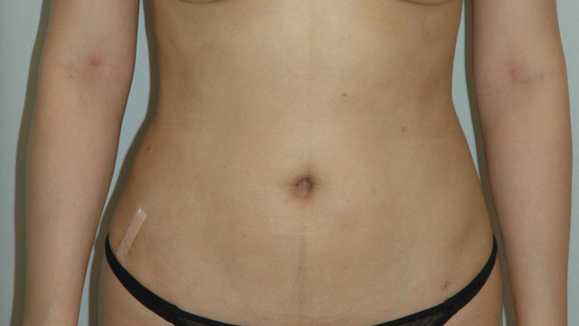 미니지방 애프터