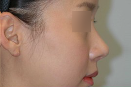 매몰법 전 AFTER 1