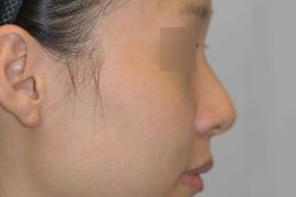 매몰법 전 BEFORE 1