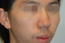 매몰법 전 BEFORE 1