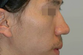 매몰법 전 BEFORE 1