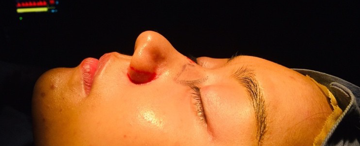 코 재수술 전면