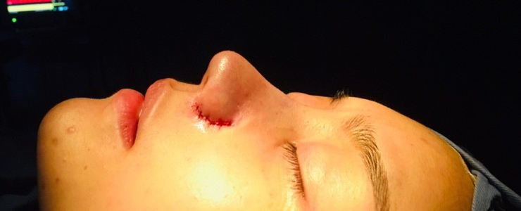 코 재수술 측면