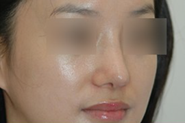 매몰법 전 AFTER 1