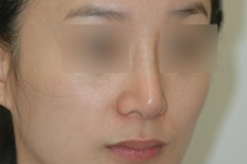 매몰법 전 BEFORE 1